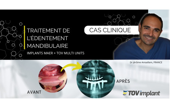 Réhabilitation mandibulaire avec implants MAER et piliers Multi-Unit TOV Implant